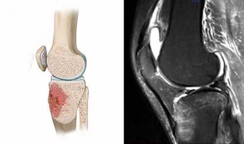 骨髓水肿是什么意思（胫骨上段骨髓水肿是什么意思）