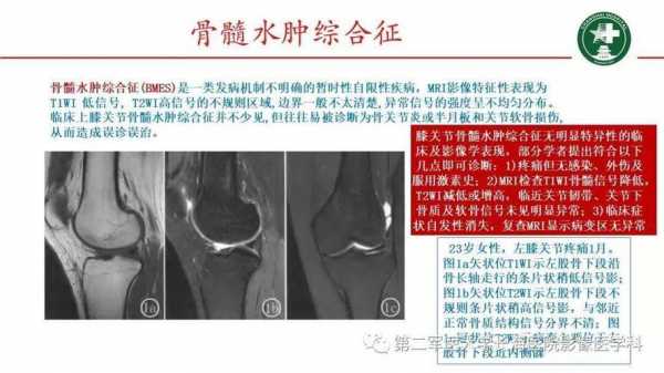 骨髓水肿是什么意思（胫骨上段骨髓水肿是什么意思）