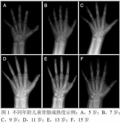 骨骼什么时候定型