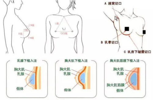 为什么要植入假体 为什么要假植