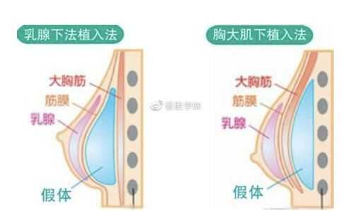 为什么要植入假体 为什么要假植