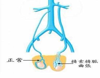 精索静脉曲张挂什么科目 精索静脉曲张挂什么科