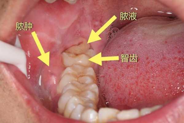 智齿为什么发炎_智齿为什么发炎的时候不能拔