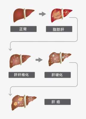 脂肪肝啥引起的