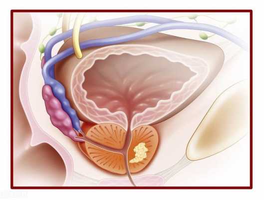 前列腺增生什么意思（前列腺增生并且钙化是什么意思）