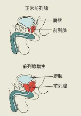 前列腺增生什么意思（前列腺增生并且钙化是什么意思）