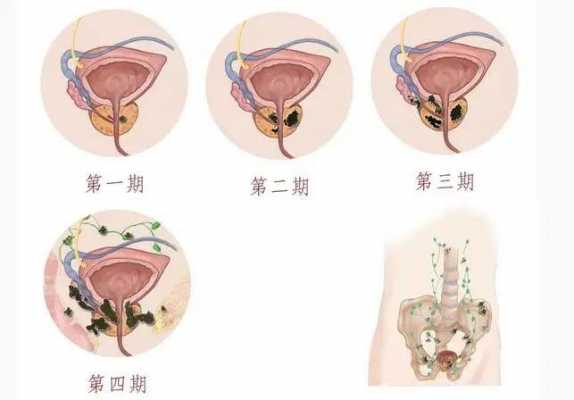 前列腺增生什么意思（前列腺增生并且钙化是什么意思）