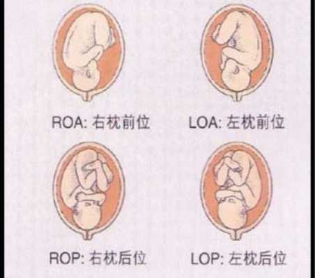 胎位roa rop 胎位roa什么意思