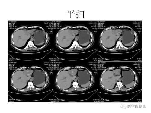 肝脏低密度灶是什么病怎么医治