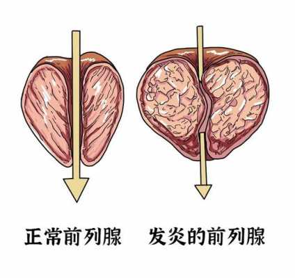 前列腺好了会不会复发