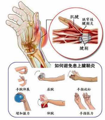 手指腱鞘炎是什么原因造成的,腱鞘炎可以自愈吗 