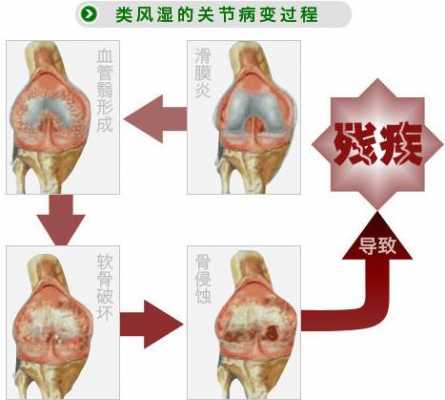 什么是类风湿关节炎,什么是类风湿关节炎有什么症状 