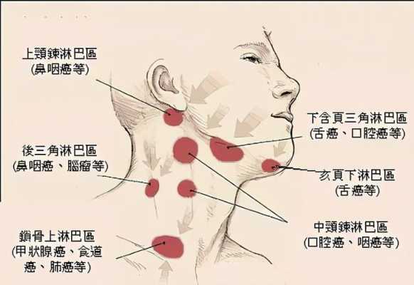 为什么淋巴会发炎（为什么淋巴发炎会呕吐）