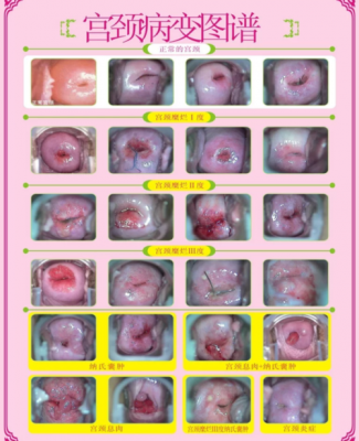 女性宫颈糜烂是什么原因引起的_宫颈糜烂怎么治才能彻底根除