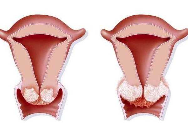 女性宫颈糜烂是什么原因引起的_宫颈糜烂怎么治才能彻底根除