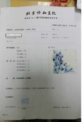  tct病变是什么意思「tct 病变」