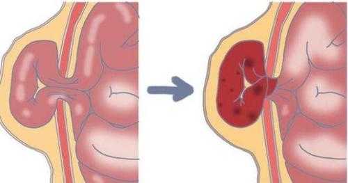 腹部包块是什么意思_腹部包块常见原因