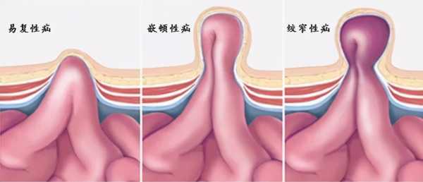 腹部包块是什么意思_腹部包块常见原因