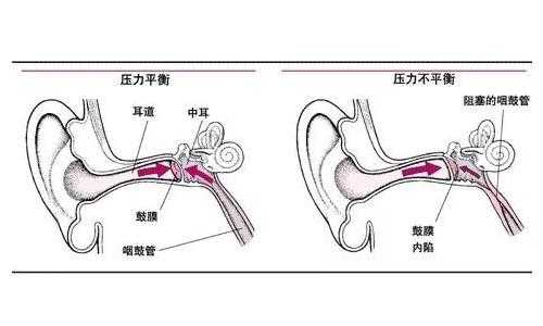  耳朵负压是什么意思「中耳炎负压自己可以怎么改善」