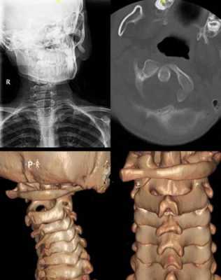 寰椎半脱位有什么症状,儿童寰枢椎半脱位多久才能好 