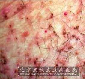  阴虱是什么症状「男性得了阴虱是什么症状」