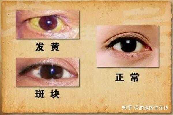  眼睛有点黄是什么原因「眼睛有点黄是不是肝有问题」