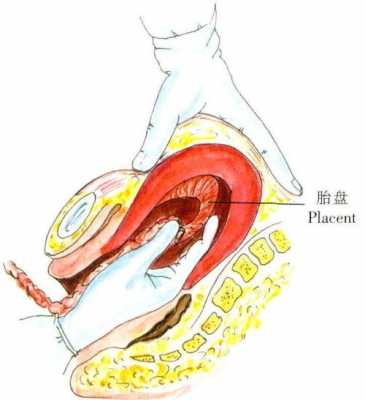 胎盘剥离是什么意思图片 胎盘剥离是什么意思