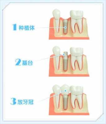 牙是什么材料_种植牙是什么材料