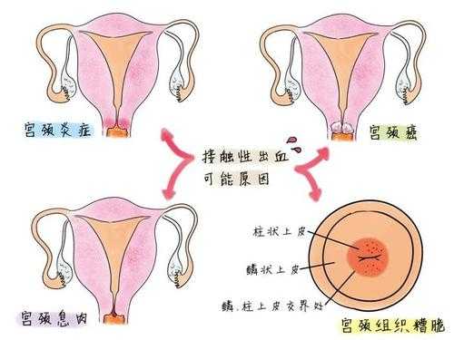 同房有轻微出血正常吗-性生活后出血什么原因