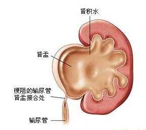 肾积水什么症状表现女性-肾积水什么症状