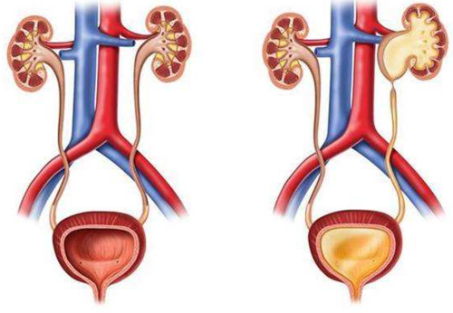肾积水什么症状表现女性-肾积水什么症状