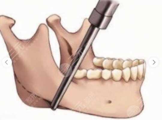 磨骨手术是什么样的全麻-磨骨手术是什么