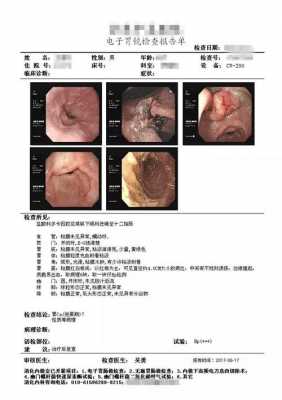 食道ca是什么意思