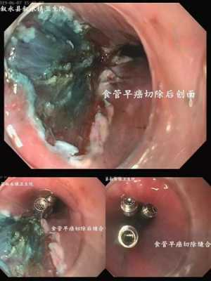 食道ca是什么意思