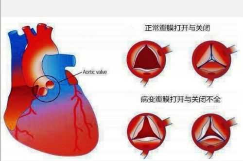  左室舒张功能障碍1级什么意思「二尖瓣三尖瓣轻度反流说明什么」