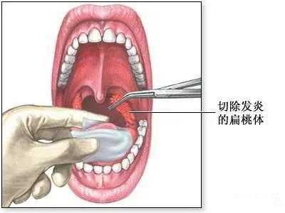 腺样体手术是什么意思 腺样体是什么意思