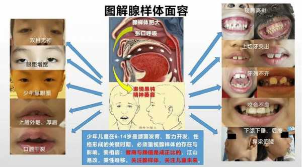 腺样体手术是什么意思 腺样体是什么意思