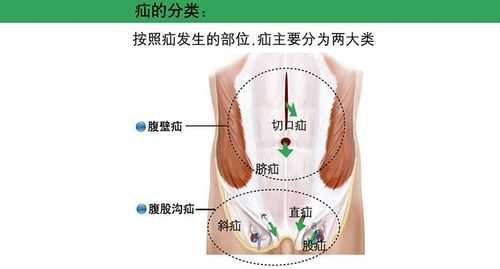 单侧腹股沟疝是什么病 疝是什么病