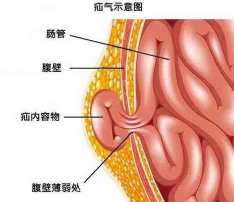 单侧腹股沟疝是什么病 疝是什么病