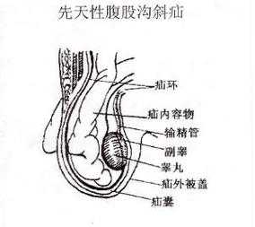 单侧腹股沟疝是什么病 疝是什么病