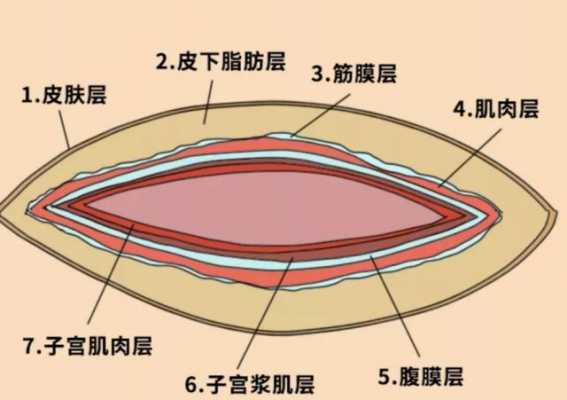 钳产是什么意思,钳产是属于顺产吗 