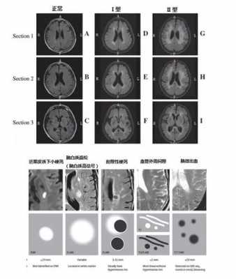 什么是脑白质病,什么是脑白质病变2级 