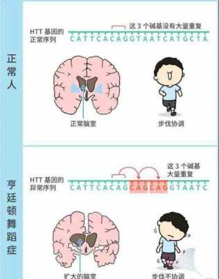  舞蹈症是什么病「哼停顿舞蹈症是什么病」