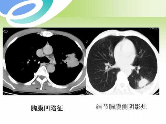  双侧胸膜肥厚什么意思「双侧胸膜增厚说明什么」