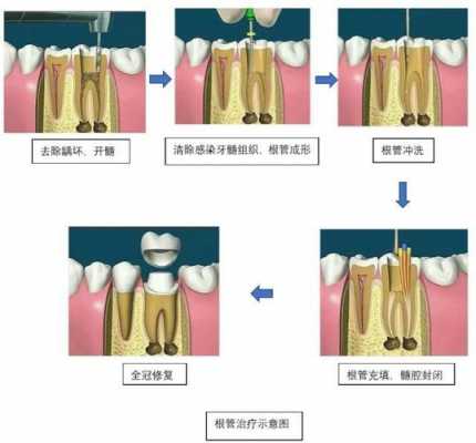 什么根管治疗_根管治疗的具体流程