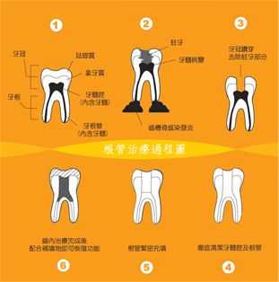 什么根管治疗_根管治疗的具体流程