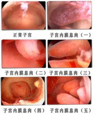 宫颈息肉是什么原因引起的,宫颈息肉是什么原因引起的做病理 