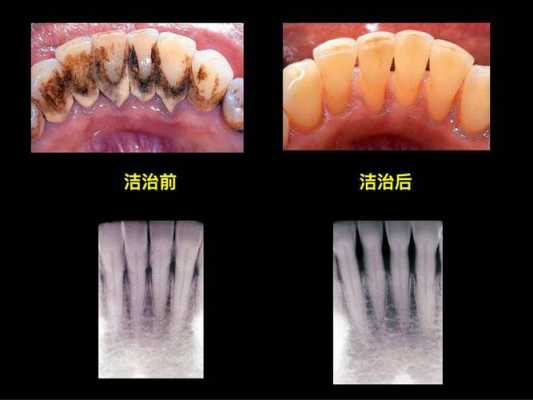 牙齿有黑色的污垢怎么才能去除 牙齿长黑渍什么原因