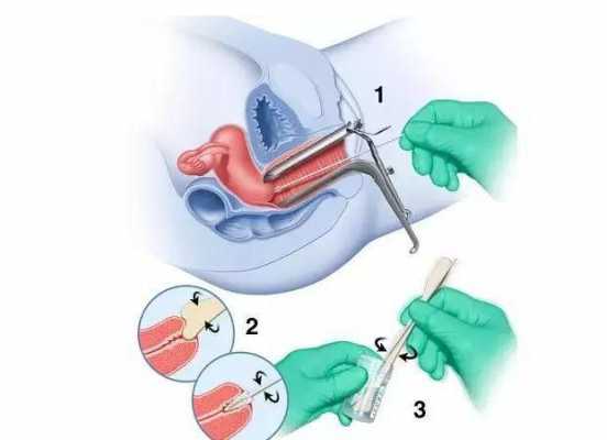 妇科活检是什么,妇科活检是什么意思 
