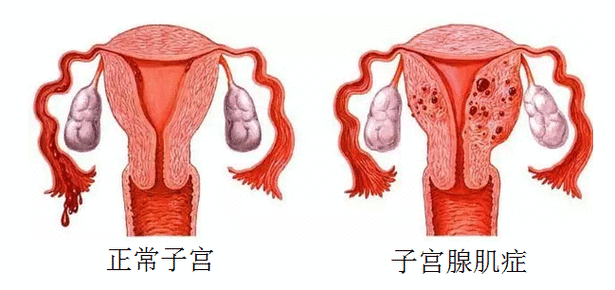  切除一侧卵巢对女性有什么影响「卵巢和输卵管切除的危害」